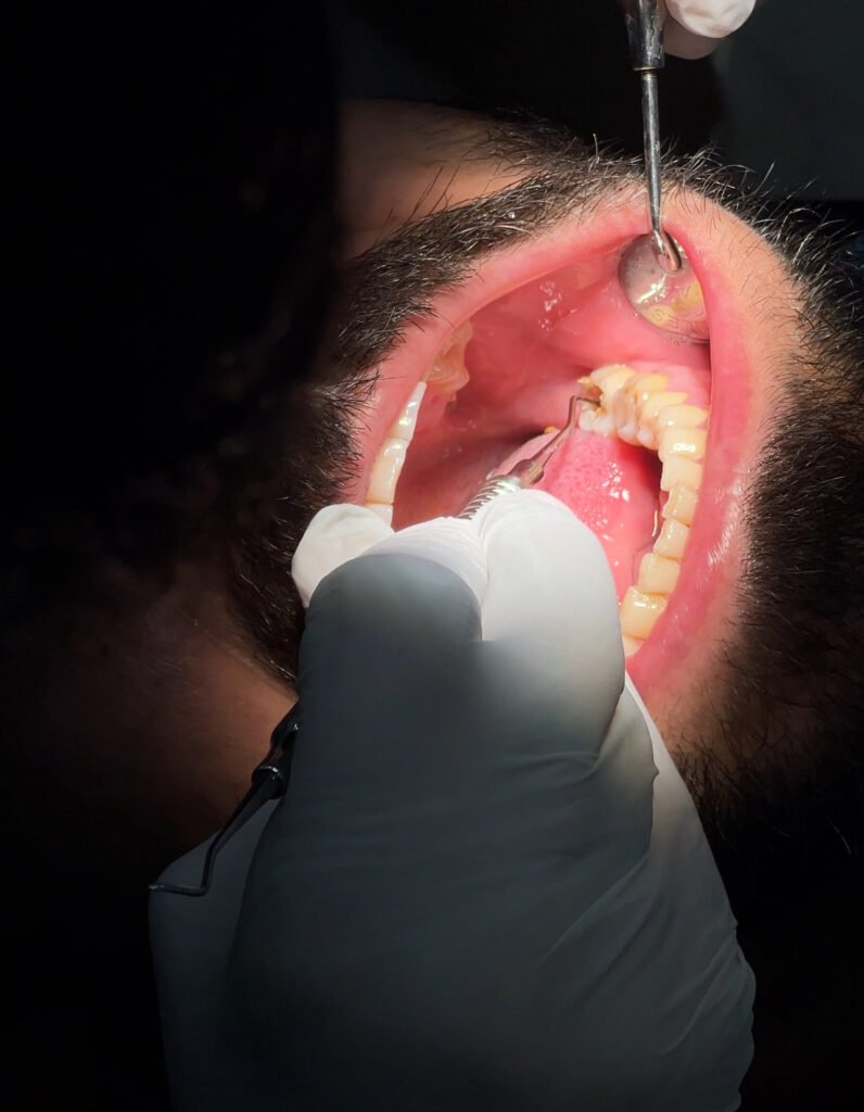 root canal